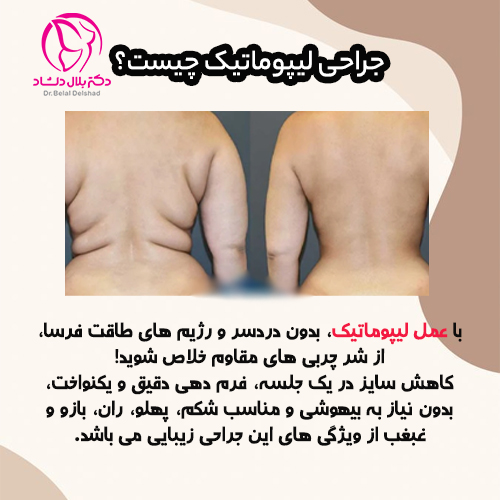 عمل لیپوماتیک چیست؟